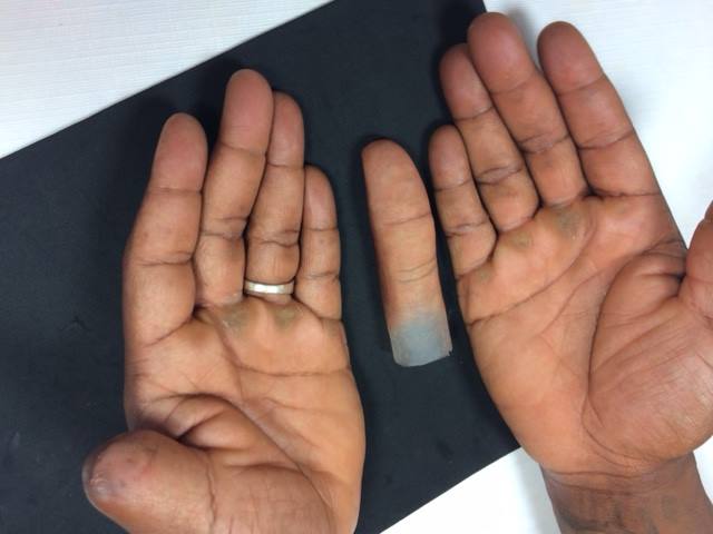 Finger Prosthetics Houston TX
