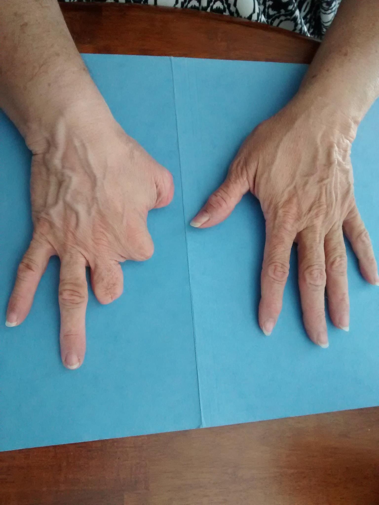 durable thumb prosthetics