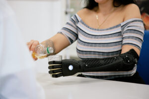How Do Custom Partial Hand Prosthetics in Memphis, TN Support Amputees With Varying Levels of Finger Loss?