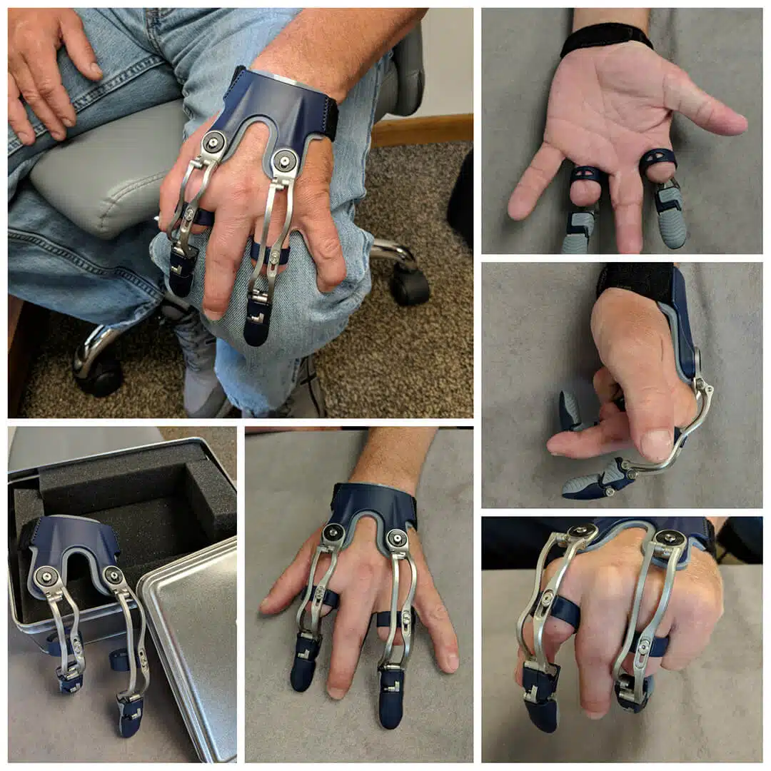 custom thumb, finger prosthetics, and partial hand prosthetics