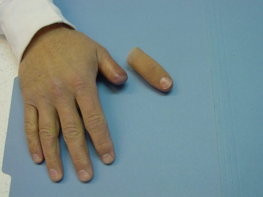 Affordable thumb prosthetics