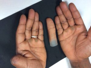 Are Personalised Prosthetic Fingers Comfortable for Long-Term Wear in Knoxville?
