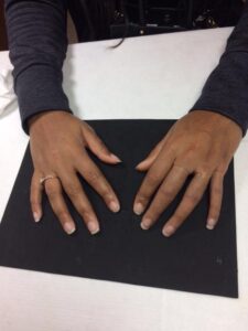 What options are available for amputee finger replacement in Lancaster, PA?
