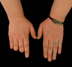 Can I Get Finger Prosthetics If My Amputation Happened Years Ago in El Paso, TX?
