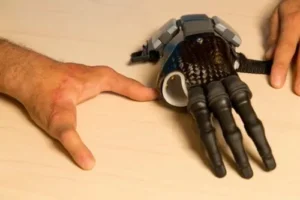What Are the Options for Thumb Prosthesis in Nashville, TN, and How Are They Fitted to Individual Needs?