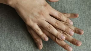 Is there a clinic for finger cut replacement or prosthetic finger in Trenton, NJ?