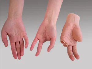 Can I Get a Custom Hand Prosthetic or Artificial Hand in Jacksonville, FL?