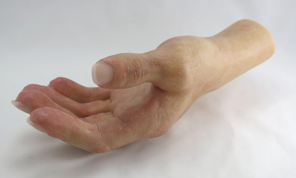 thumb prosthetic