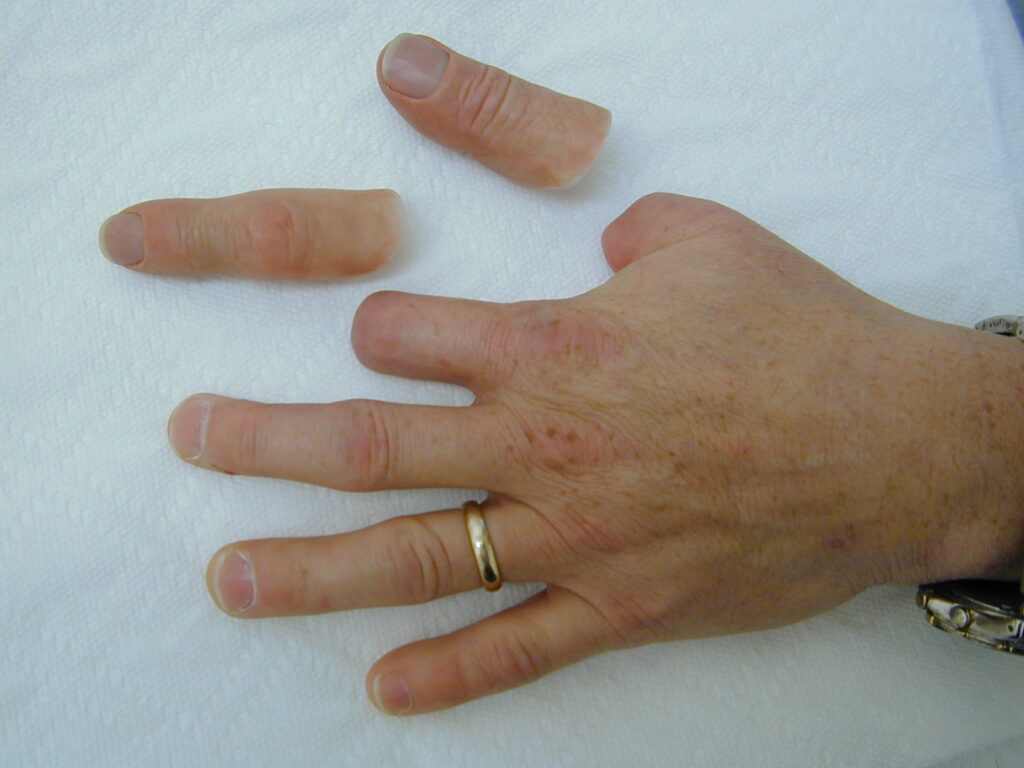 functional thumb prosthetics