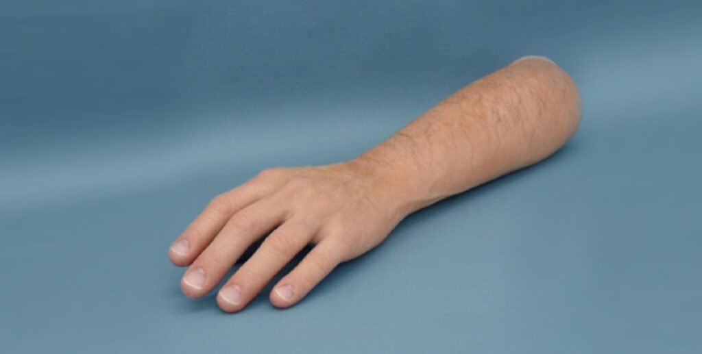 Partial arm prosthetics