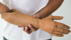 How Does a Custom Hand Prosthetic Improve Daily Activities for Amputees in Houston?