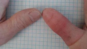 Are there affordable thumb prosthetics for amputees in Columbus, OH?