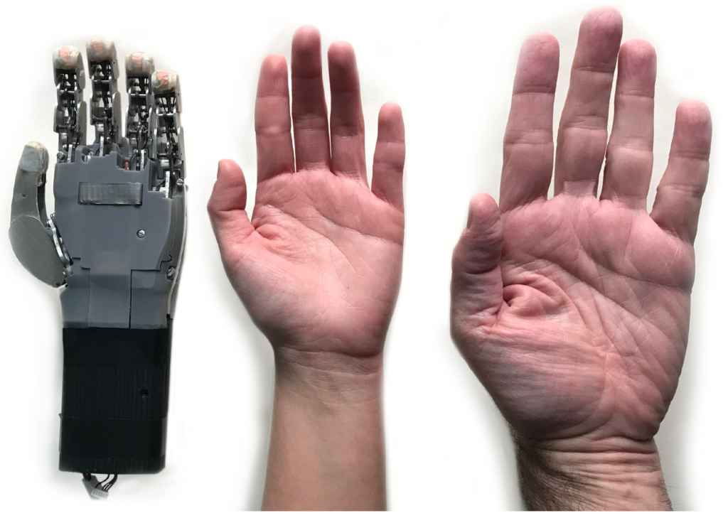 Hand Prosthesis Specialist