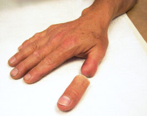 Are finger, hand, and thumb prosthetics covered by insurance?