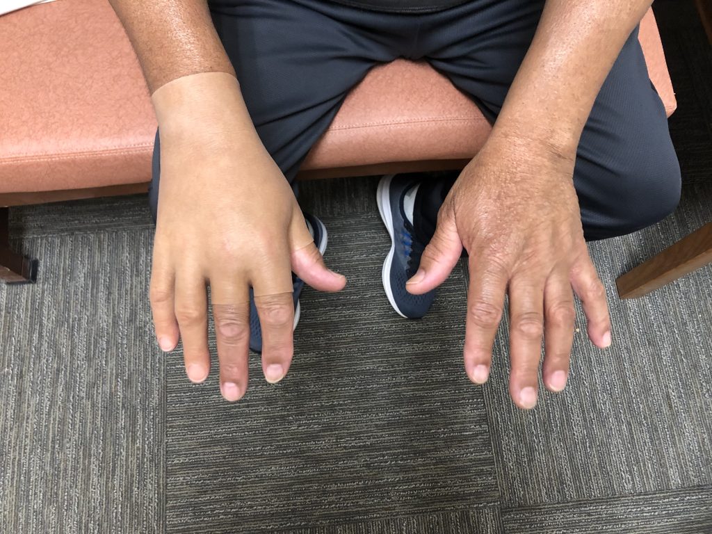 partial hand prosthetic in Raleigh, NC