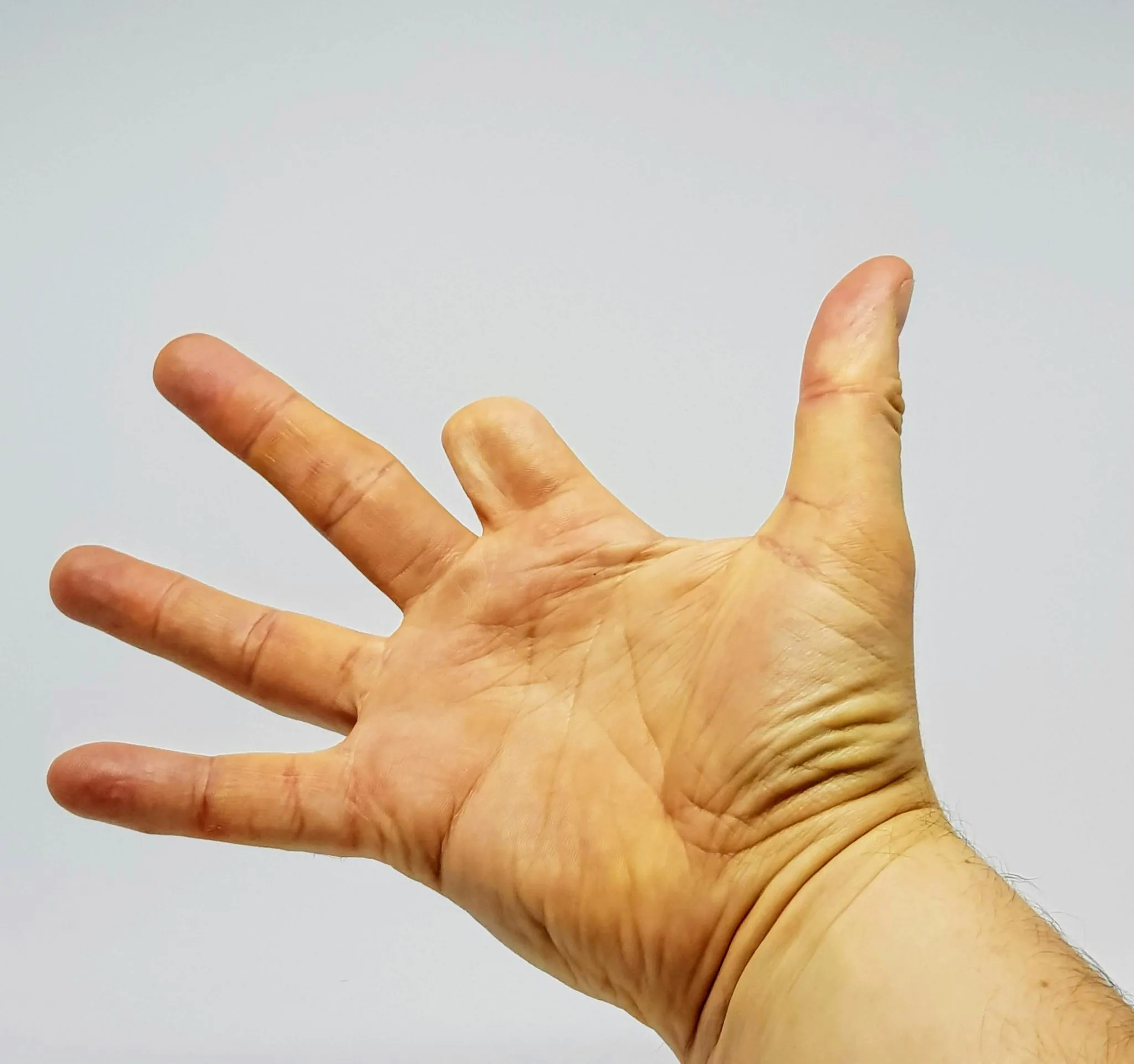 Custom Finger Amputation Prosthetics