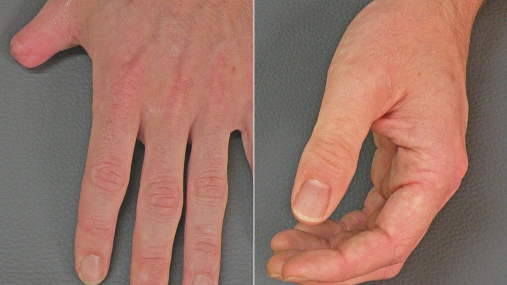lifelike custom thumb prosthetics