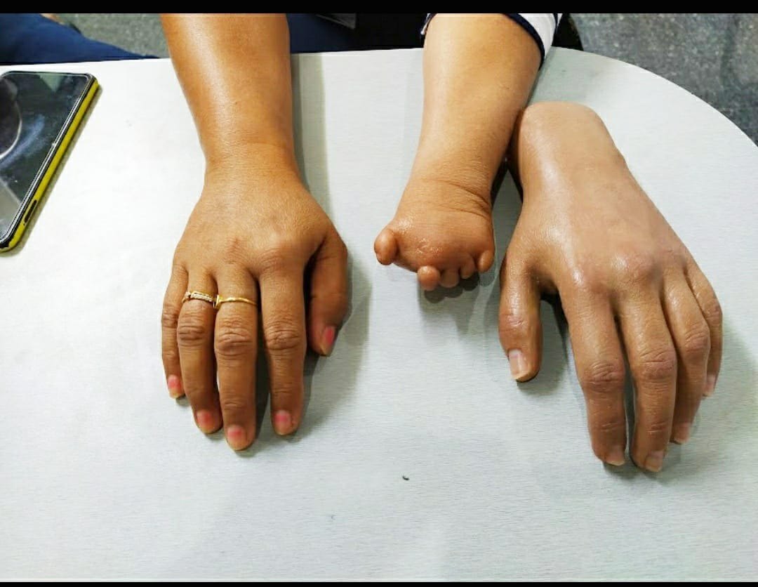 partial hand prosthetics