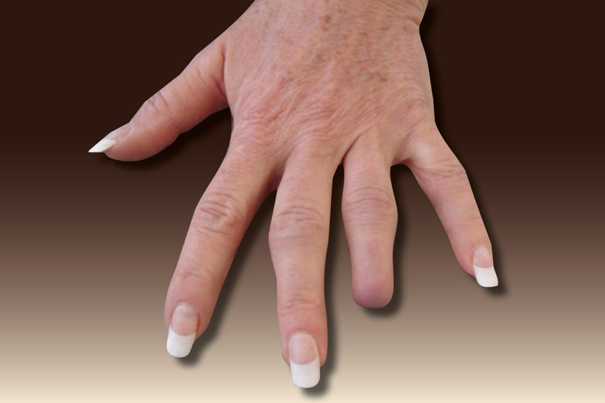 How Much Does a Custom Finger Prosthetic Cost? Everything You Need to Know Before You Ask