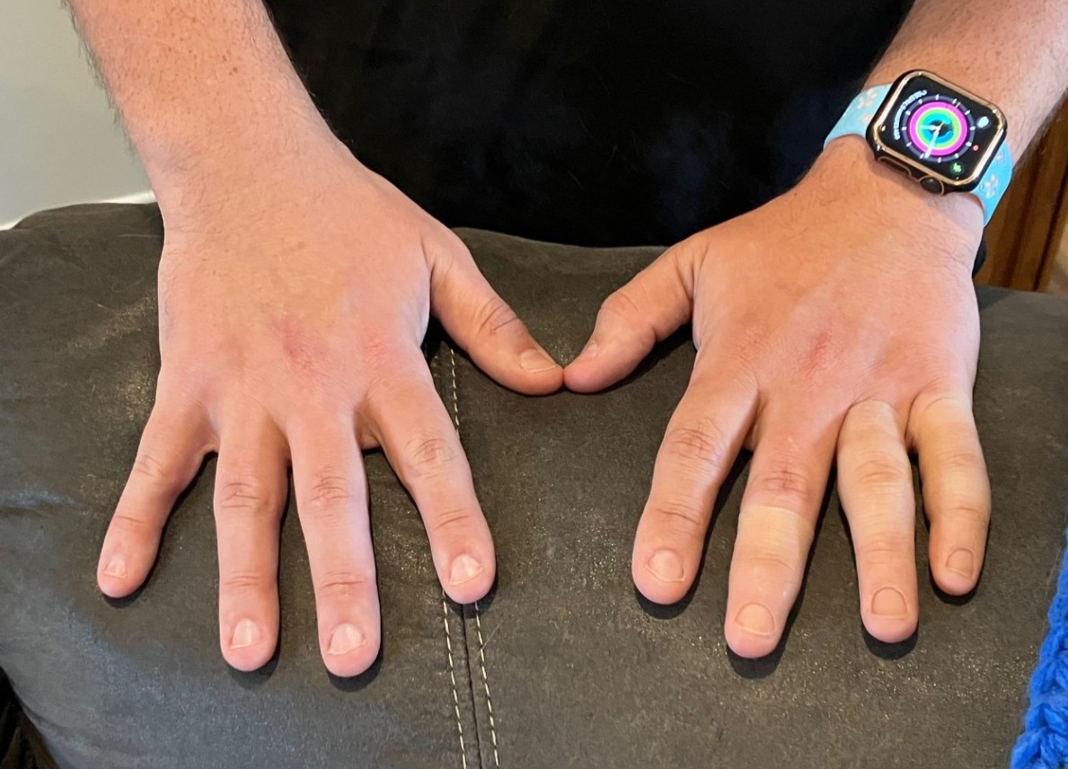 permanent prosthetic finger