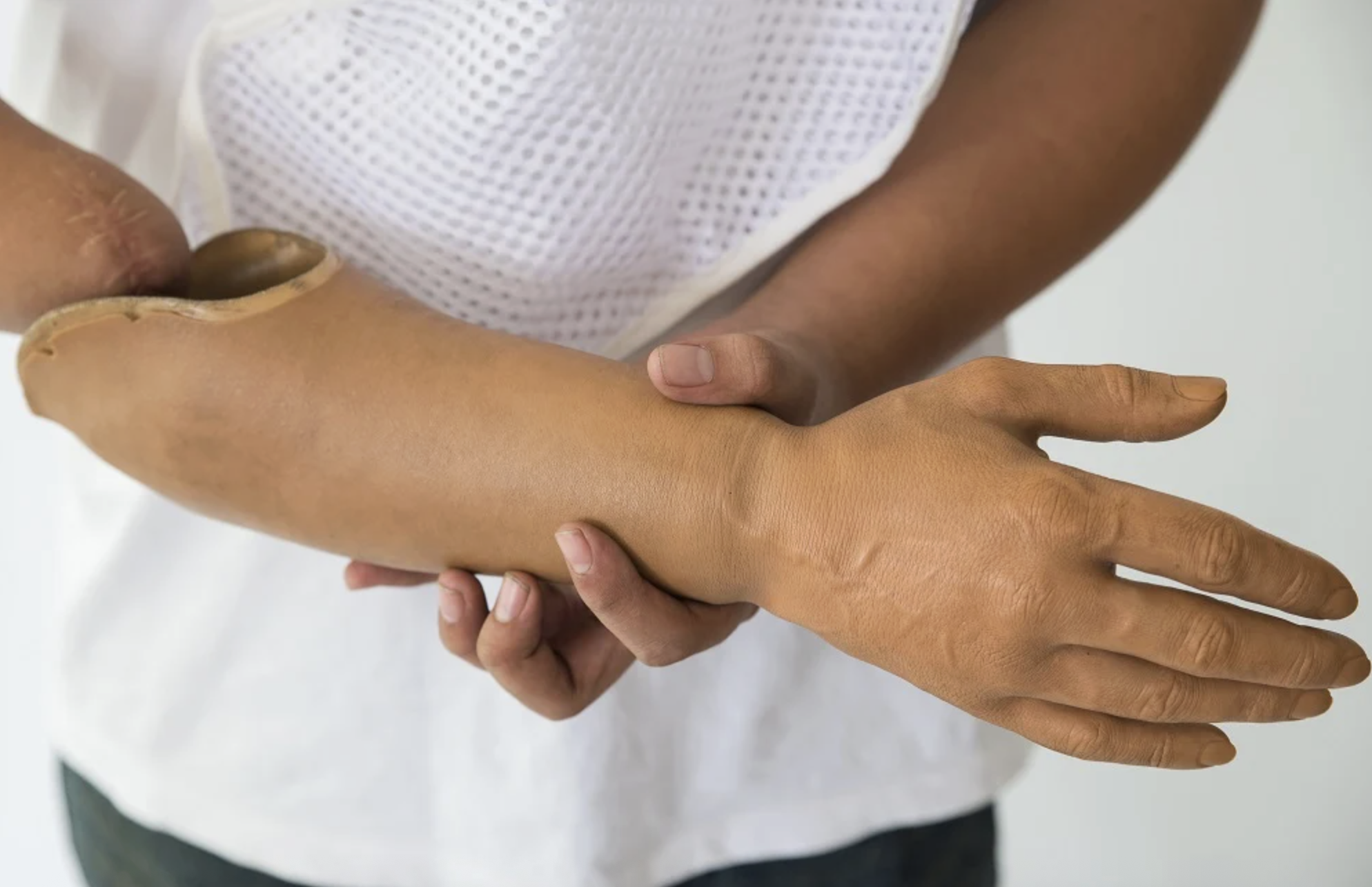 affordable hand prosthetics in Albuquerque